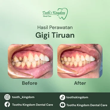 Gigi palsu estetik yang terlihat seperti gigi asli di Cipete Jakarta Selatan, hasil rapi dan natural.
