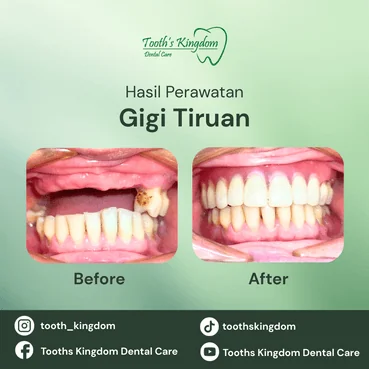 jaket gigi porcelain metal harga terjangkau di Cipete, Jakarta Selatan.