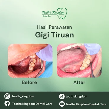 Pemasangan crown gigi zirconia yang kuat dan anti pecah di Kelapa Gading, Jakarta Utara.
