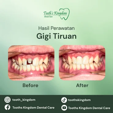 Layanan pembuatan gigi tiruan lengkap berkualitas di Benhil Jakarta Pusat, solusi gigi ompong