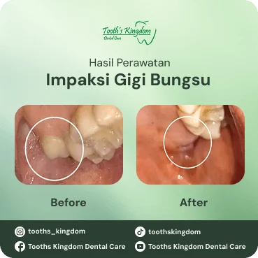 Foto perbandingan before-after perawatan impaksi gigi bungsu di Tooth's Kingdom Dental Care.