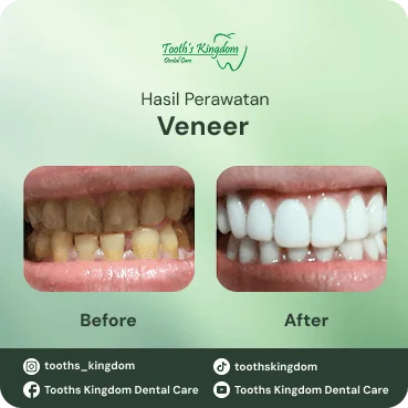 Perbandingan sebelum dan sesudah veneer gigi untuk memutihkan gigi kuning di Tooth's Kingdom