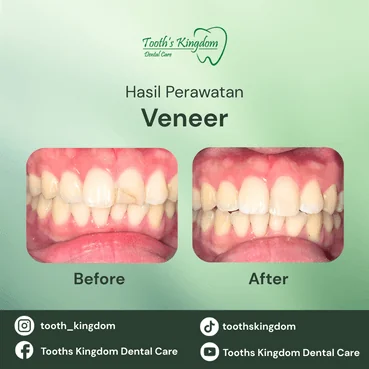 Hasil before after veneer gigi putih alami di klinik gigi Tooth Kingdom.