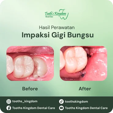 Hasil pencabutan gigi bungsu impaksi di klinik gigi Tooths Kingdom