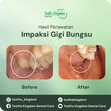 Hasil nyata pencabutan gigi bungsu tanpa bengkak di klinik gigi Tooth's Kingdom cabang Kelapa Gading.