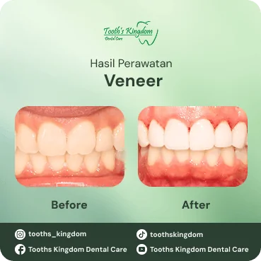 Foto asli before-after pemasangan veneer gigi porselen kualitas premium di Tooth's Kingdom Kelapa Gading